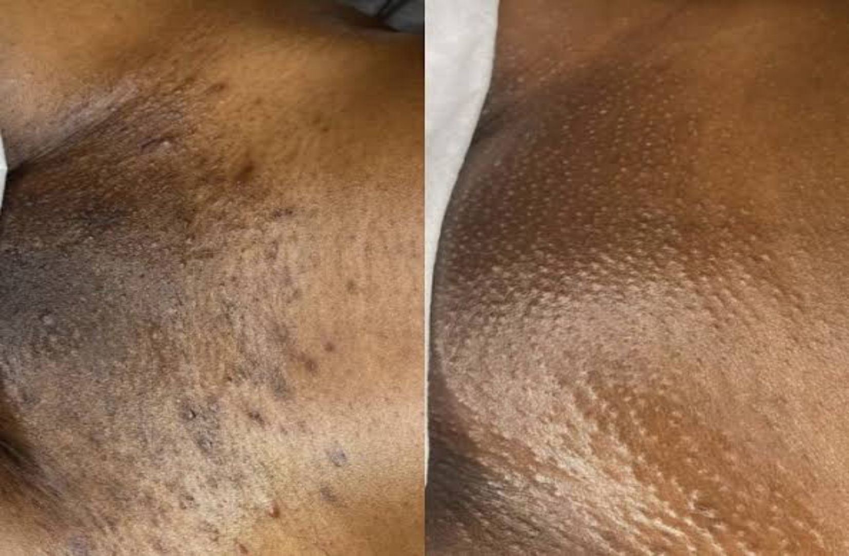 Vajacial Treatment at Patty's Beauty Spa